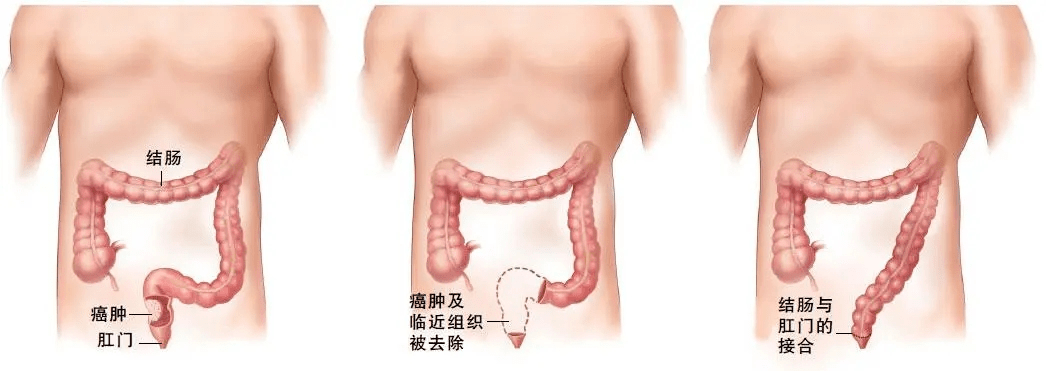 【圖:直腸癌切除術】術中,醫生們會切除患者十二指腸,肝外膽管,膽囊