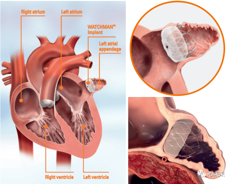 左心耳封堵适应症图片
