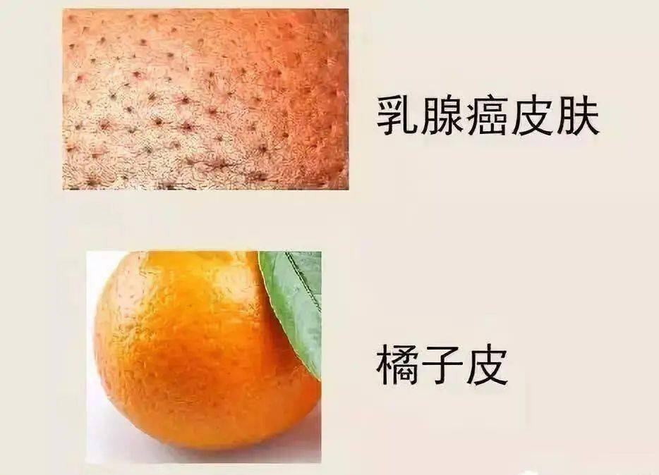 橘皮样乳房图片图片