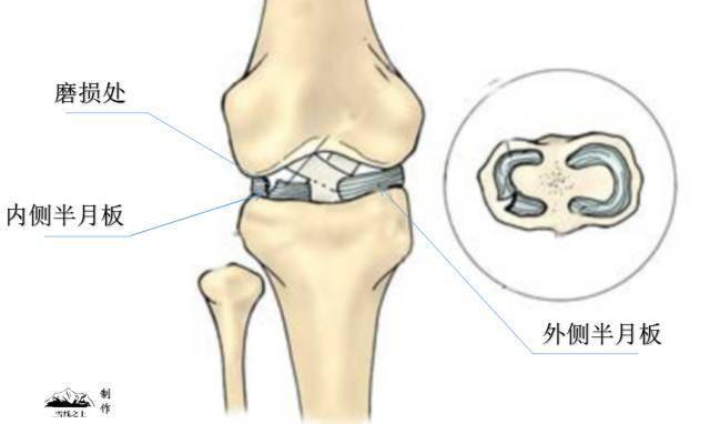 2,半月板:緩衝關節震動和保護膝關節的主要部位.