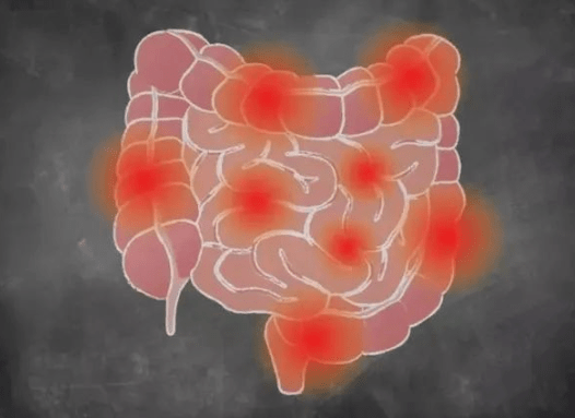 研究表明:間充質幹細胞或將是治療克羅恩病的新希望_患者_發病_腸道