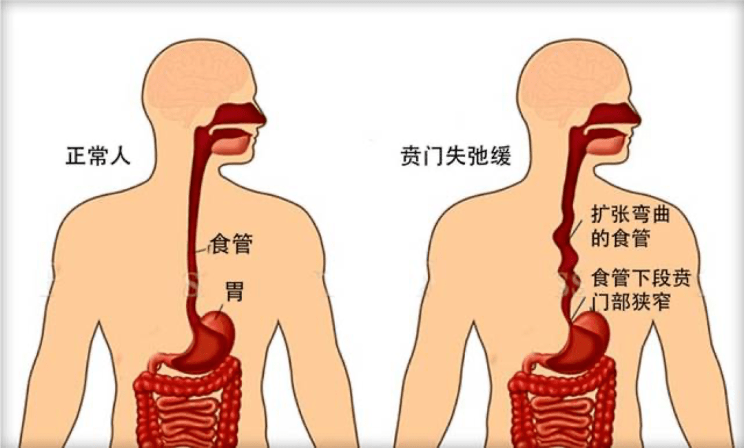 贲门失弛缓症 吞咽困难