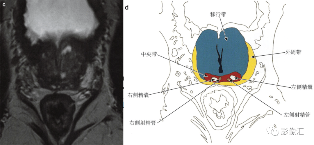 中央帶在解剖學上被定義為從前列腺底部到精阜環繞射精管的區域(圖5.