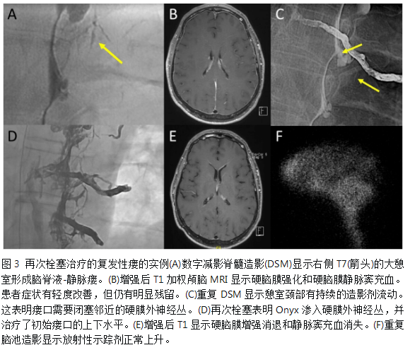 jnis中文版丨黃理金教授導讀:經靜脈栓塞治療100例腦
