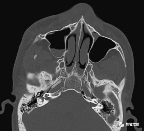 颧骨ct断层解剖图片
