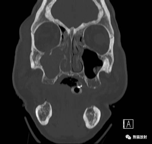 【急診】顴骨骨折,上頜骨骨折ct表現_fort_竇前壁_竇外