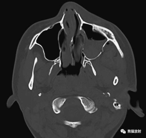 【急診】顴骨骨折,上頜骨骨折ct表現_fort_竇前壁_竇外