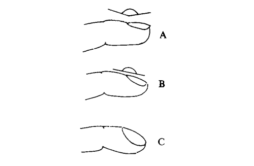 正常人拇指基底角约160°杵状指测量方法图中表示各种类型的杵状指,n