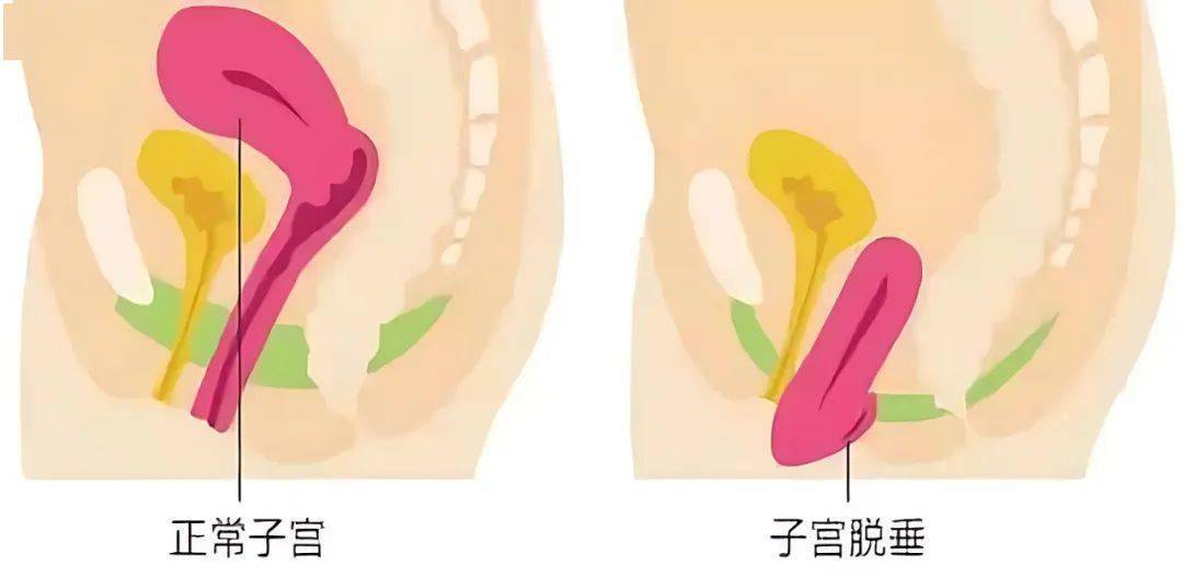 宫颈内口松弛图片图片