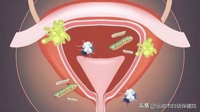 运城妇科炎症