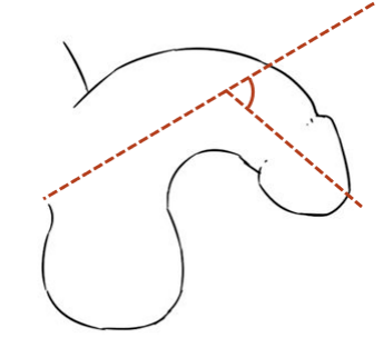 超早产男宝又遭遇尿道下裂,不及时手术"性福"难保_阴茎_小儿_治疗