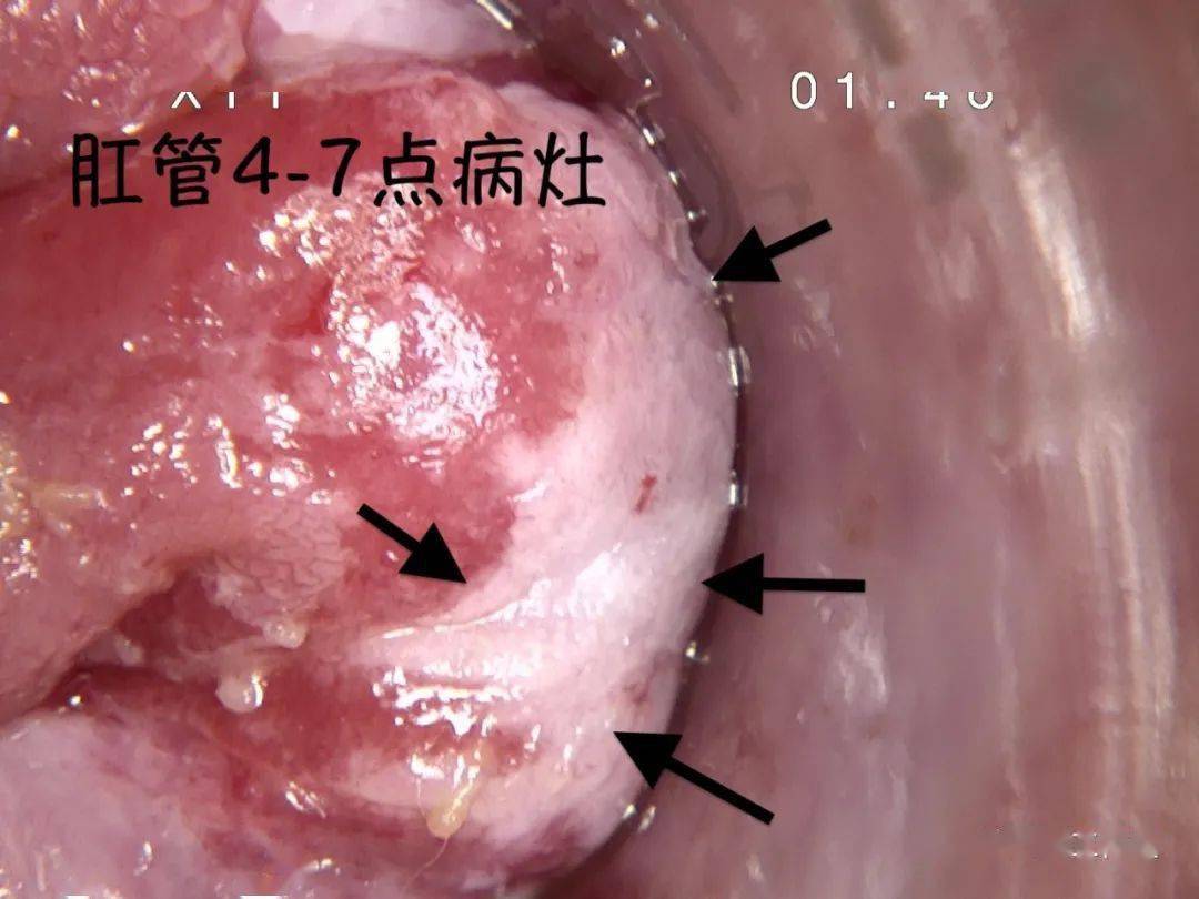 醋酸白使用前后对比图片