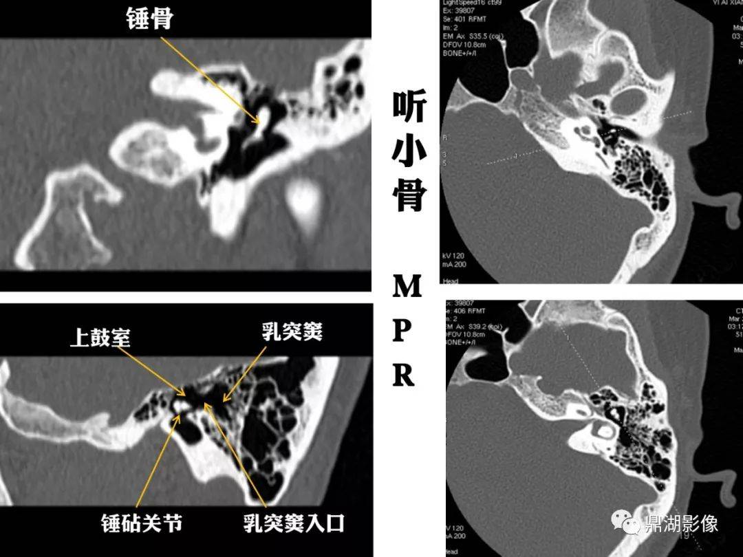 頭頸部高清ct斷層解剖(全)_全網_影像_系統