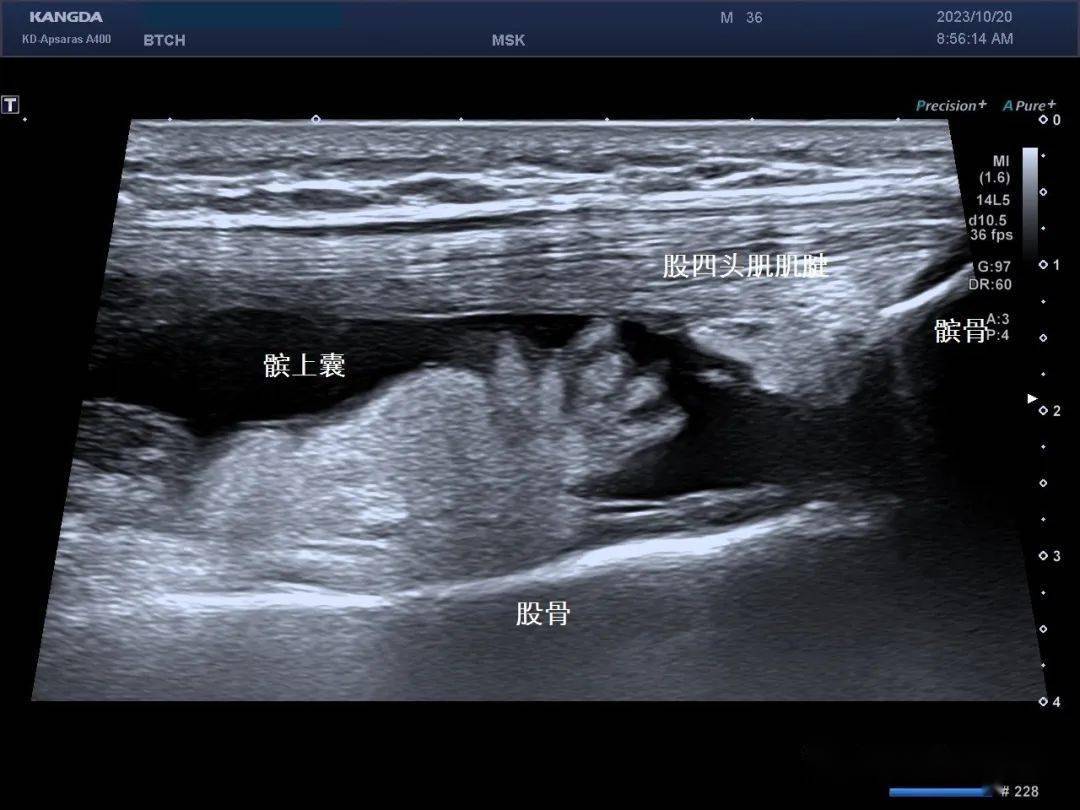 髌上囊超声图片图片